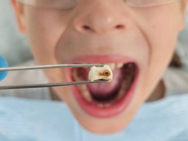Best Emergency Dentist for Lost Fillings or Crowns in Shelton, CT